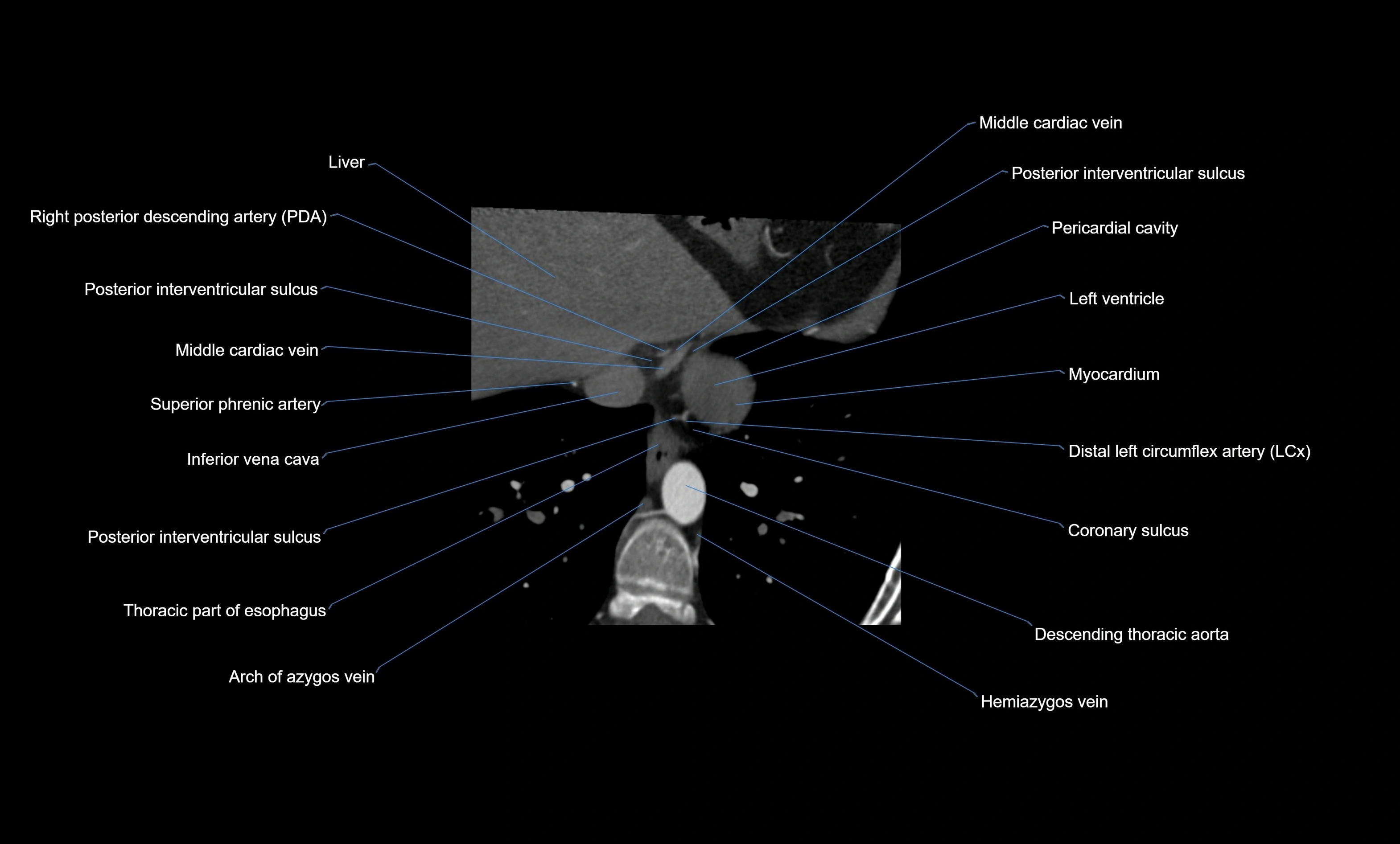 CT heart (coronary angiogram) four chamber view  cross sectional anatomy labelled radiology image -00041.webp